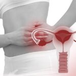 Pelvic Inflammatory Disease While Pregnant
