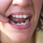 Invisalign Treatment for Crowded Teeth Issues